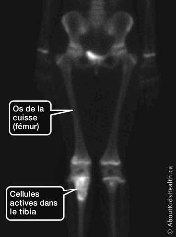 scintigraphie montrant des cellules actives dans le tibia