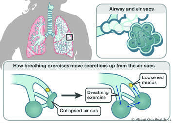 Close up of the air sacs in the lungs showing how breathing exercises can help to move secretions from the air sacs up into the larger airways