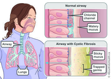 Comparison of a normal airway with watery mucus to cystic fibrosis airway with sticky mucus