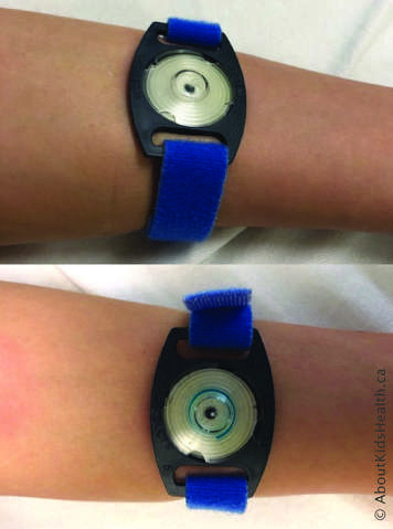 Sweat chloride test showing a sweat collection device on someone’s arm at the beginning of the test and during the test as the coil starts to turn blue