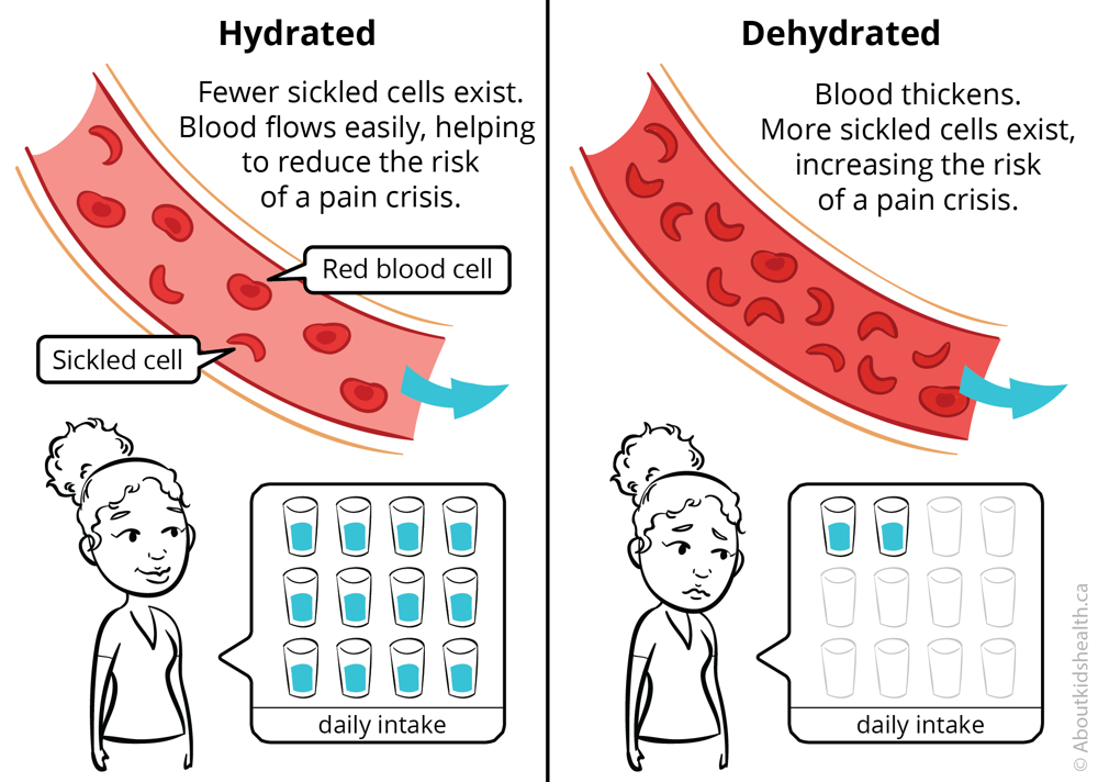 In someone who's dehydrated, blood thickens and more sickle cells exist, increasing the risk of a pain crisis