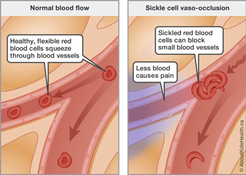 Healthy red blood cells squeeze through blood vessels; sickled red blood cells block small vessel, causing less blood flow