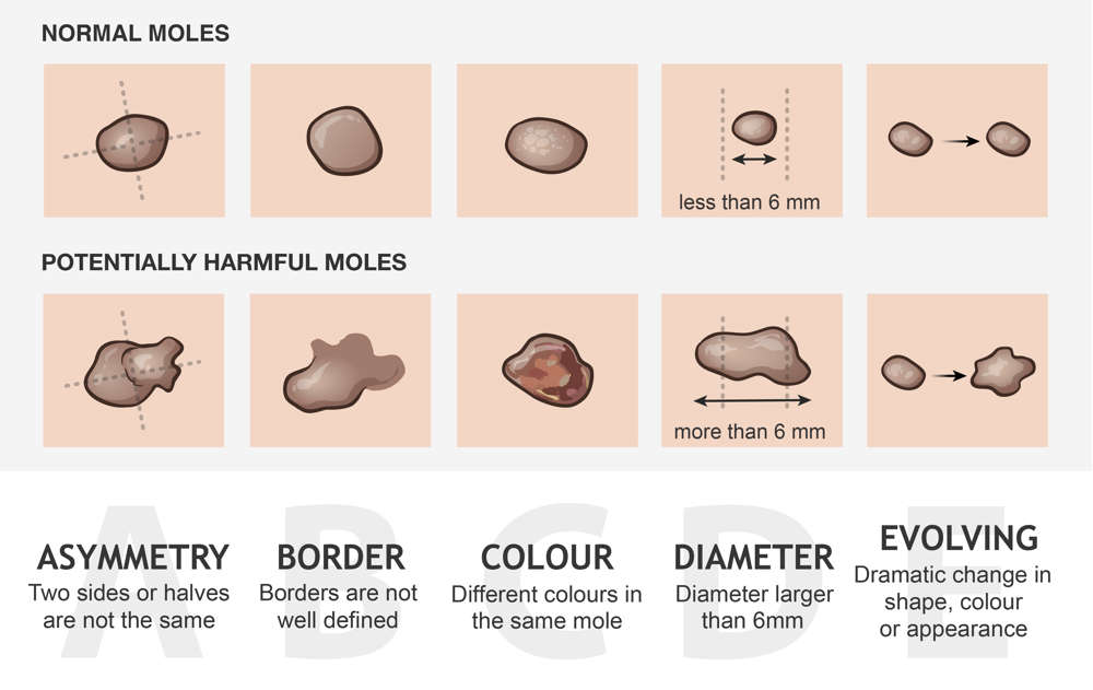 Illustration of normal moles and potentially harmful moles according to ABCDE guide