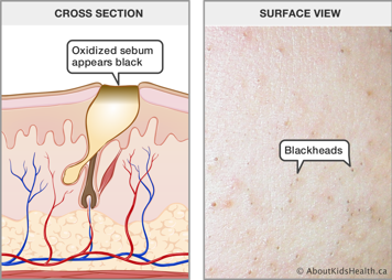 Cross section of skin with an oxidized sebum, which appears black at the top, and a surface view of skin with blackheads