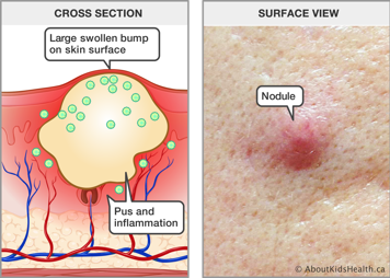 Cross section of pus and inflammation under the skin with large swollen bump on skin surface, and surface view of nodule