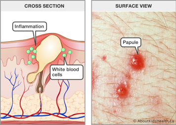 Cross section of skin with inflammation and white blood cells around sebum, and surface view of skin with papules