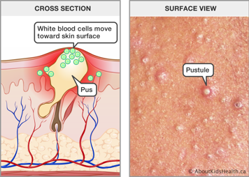 Cross section of pus under the skin and white blood cells that have moved toward the surface, and surface view of pustules