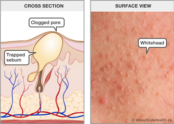 Cross section of skin with a trapped sebum and clogged pore, and a surface view of skin with whiteheads
