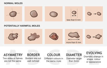 Illustration of normal moles and potentially harmful moles according to ABCDE guide