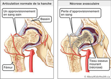 La perte d'approvisionnement en sang entraîne la mort du tissu osseux (nécrose) dans une articulation de la hanche