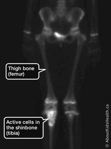 bone scan showing active cancer cells in the shinbone