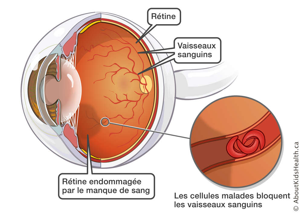 Rétine endommagée par un manque de sang dû à des cellules malades bloquant les vaisseaux sanguins de la rétine