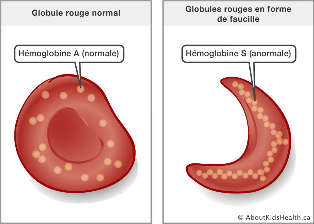 Globule rouge normale avec hémaglobine A et globule rouge en forme de faucille avec hémoglobine S
