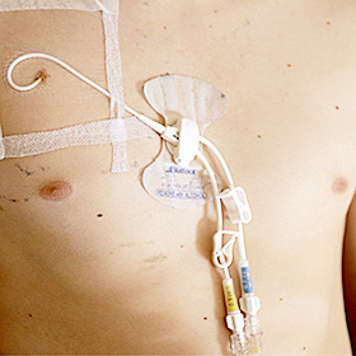 Teen boy with central venous line in his chest