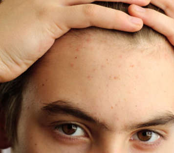 Teen boy with acne on forehead